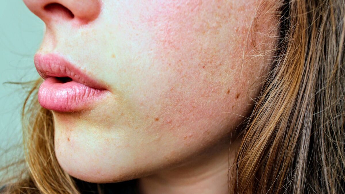 Close-up van een gezicht met droge huid